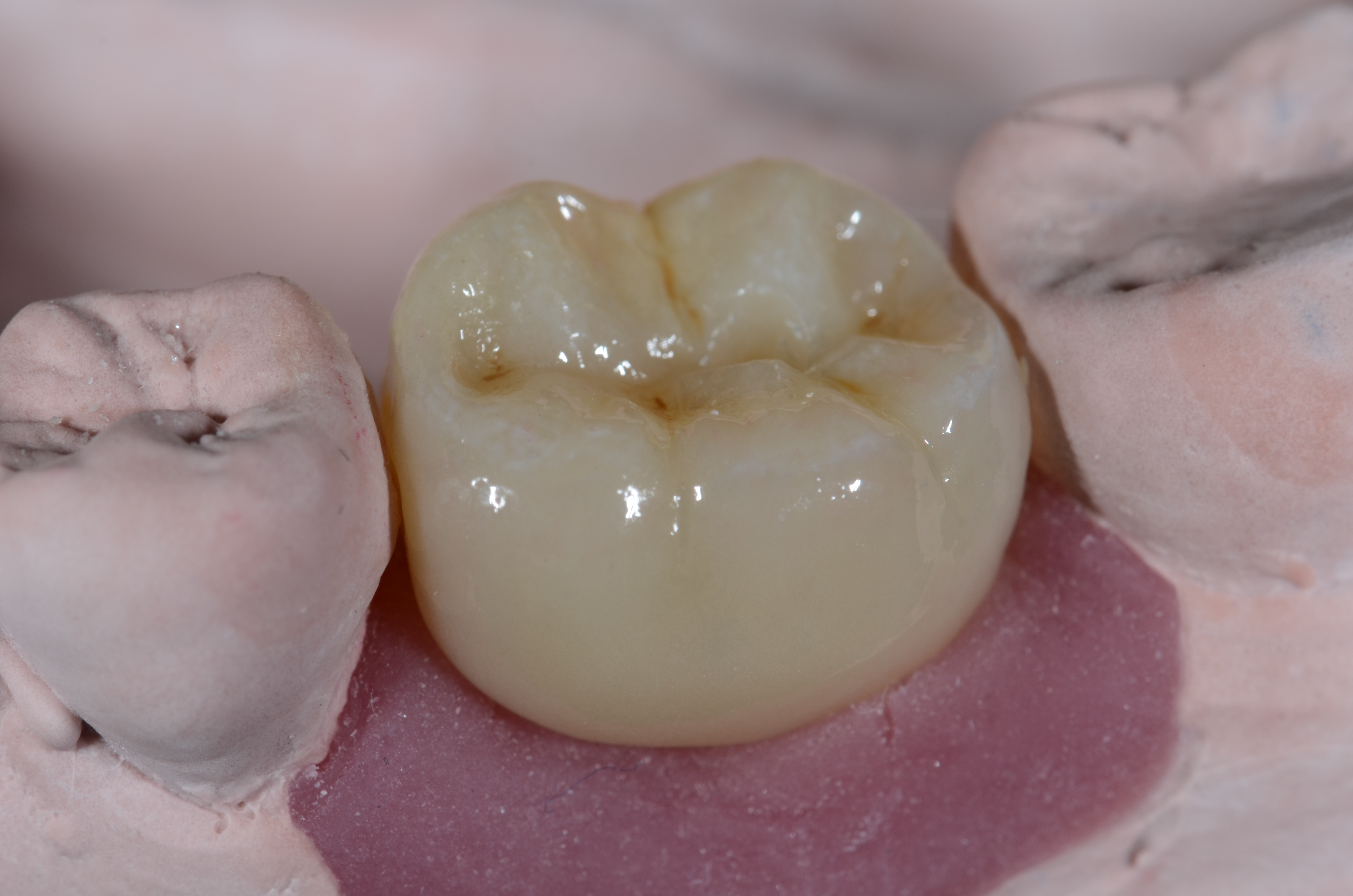 Temp Implant Crown